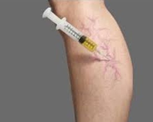 Varicose vein laser / Venous ulcer treatment