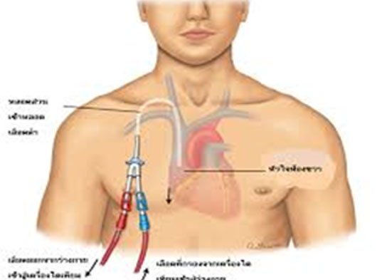 permcath or tunnelled catheter